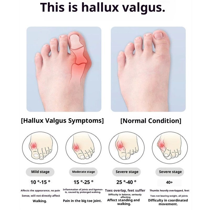 Bunion Relief Sleeves Bunion Pads Brace Cushions Toe Straightener Hallux Valgus Relief Kit Pack (small)